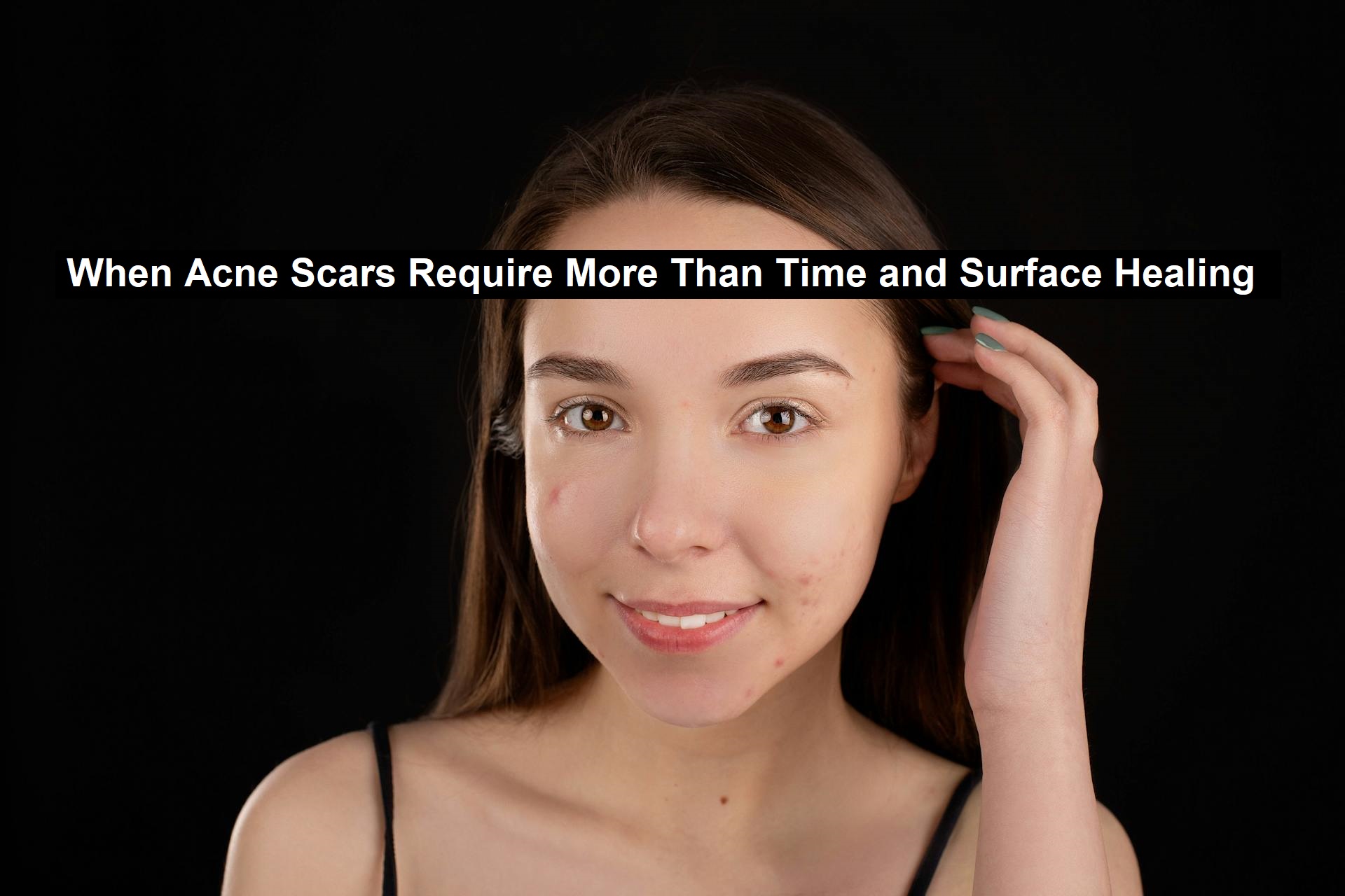 Acne Scars